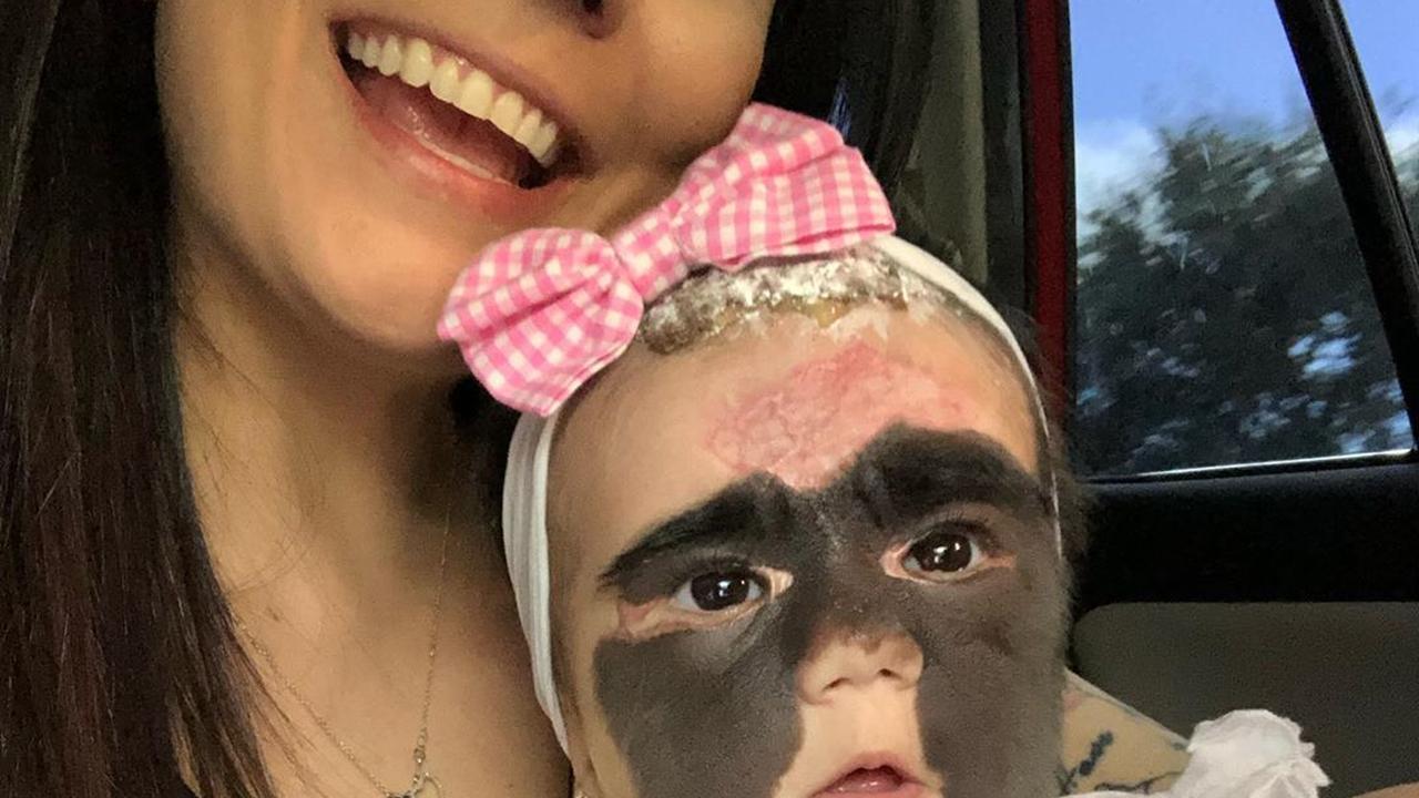 девочка луна из америки с маской бэтмена. девочка с родимыми пятнами. девочка с родимыми пятнами. девочка луна с родимым пятном. луна фенер павел попов невус краснодар.