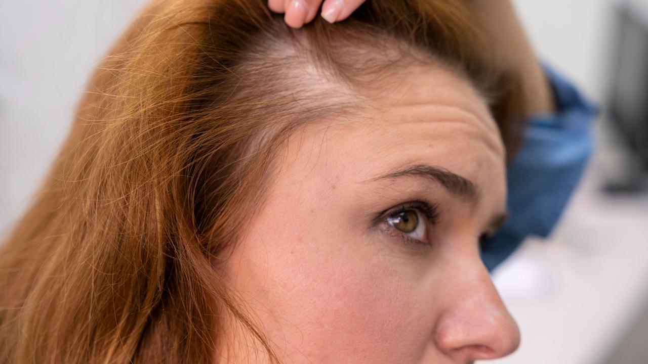 Причину выпадения волос после 40. Прическа для выпадающих волос. Выпали волосы у блогера. Лечение волос до после у женщин.