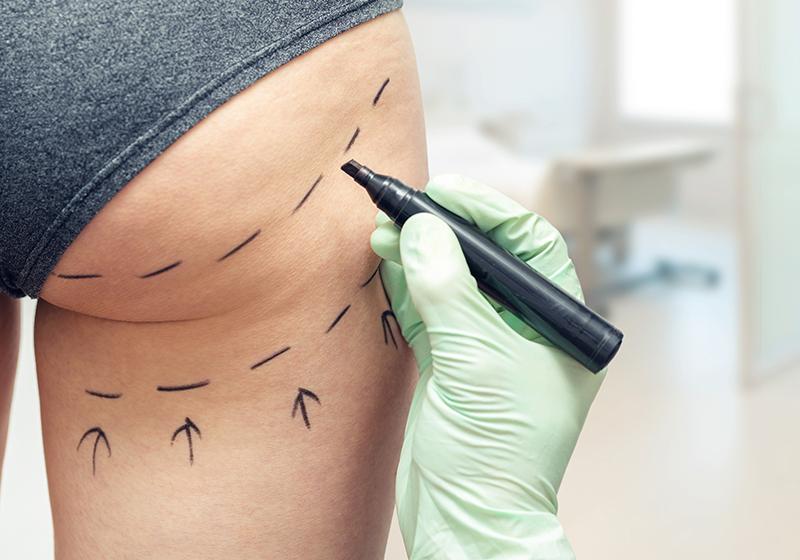 Определение body-скульптурирования