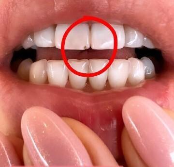 Анфиса Чехова во сне откусила себе зуб