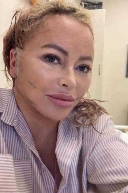 «Анализы совершенны»: Дана Борисова показала результат очередной пластики лица