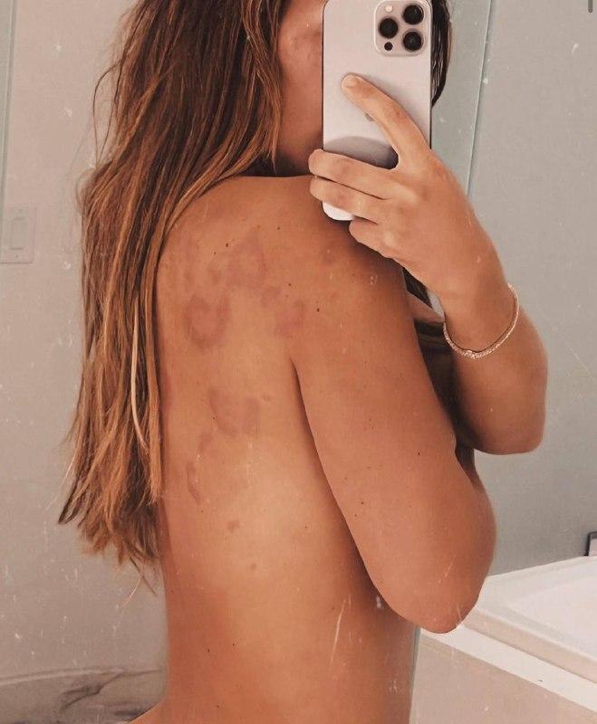 Анна Седокова страдает от аллергической реакции