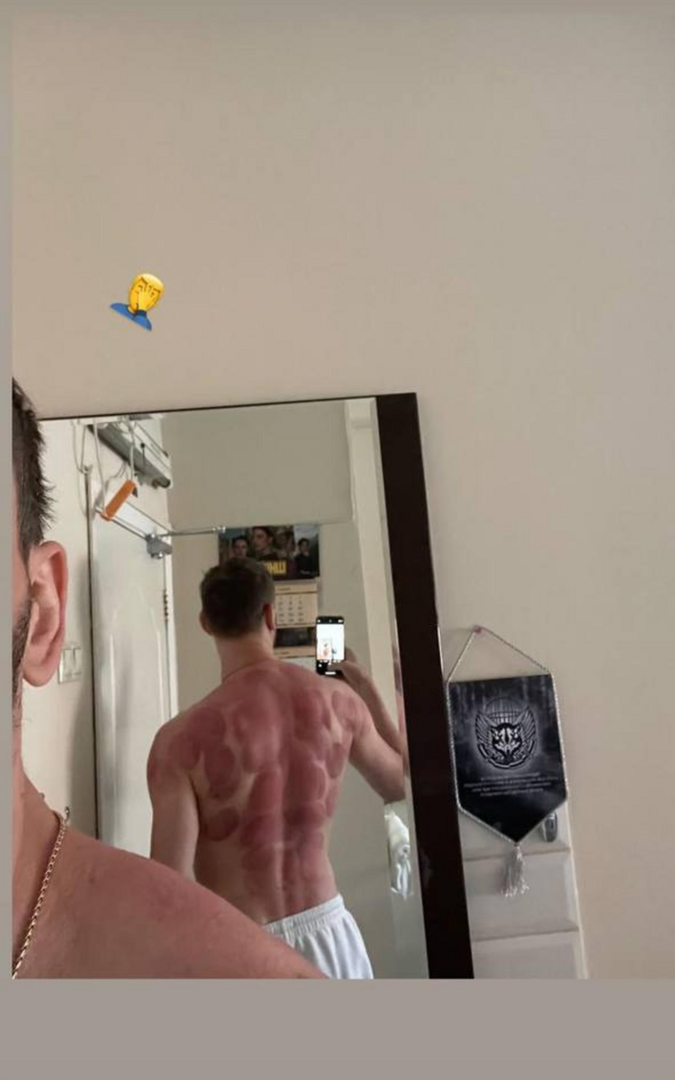 Муж Леры Кудрявцевой опубликовал фото с синяками на теле