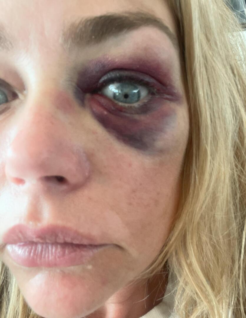 «Сжимал голову, заламывал руки, бил по лицу и голове»: «девушка Бонда» Дениз Ричардс обвинила мужа в избиениях