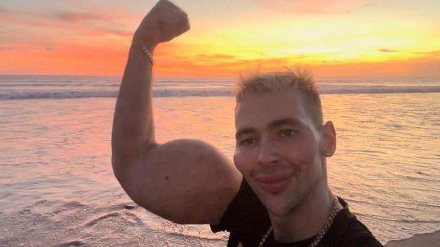 «Ты что, в улей залез за медом?»: Интернет-знаменитость «руки-базуки» ужаснул фанатов своим лицом