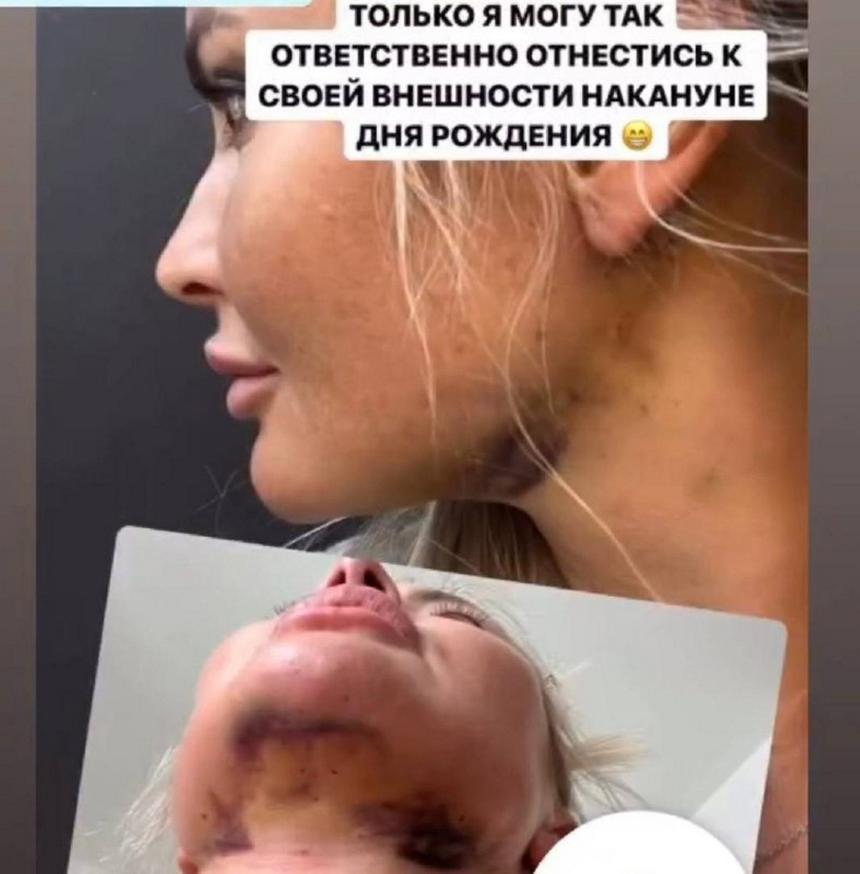 47-летняя Дана Борисова напугала кровоподтеками на лице после неудачной бьюти-процедуры