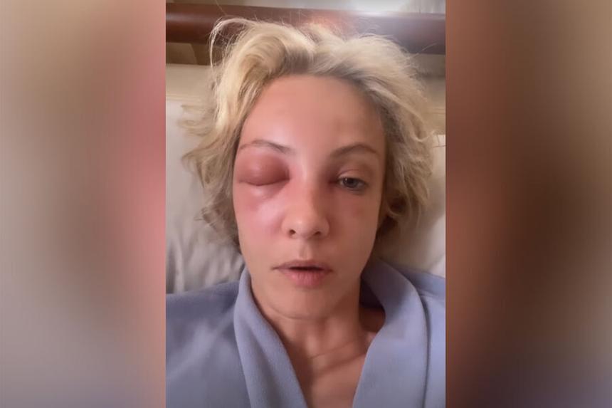Глаз не открывается: Полина Максимова показала последствия жуткой аллергии из-за укуса пчелы