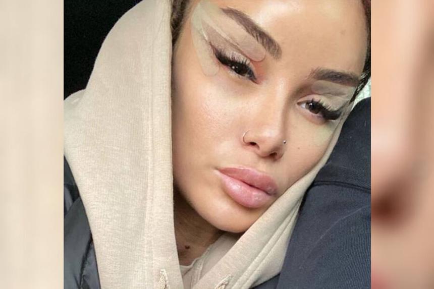 «Теперь я восхищаюсь собой»: Айза показала первые фото после пластики лица